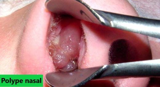 Traitement naturel polype nasal. Soigner les polypes nasales avec le thym