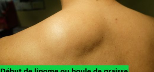Traitement naturel boule de graisse lipome sans chirurgie, lipomatose
