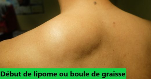 Traitement naturel boule de graisse lipome sans chirurgie, lipomatose