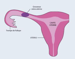 grossesse extra utérine symptomes