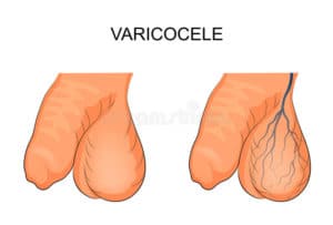 varicocèle traitement non chirurgical