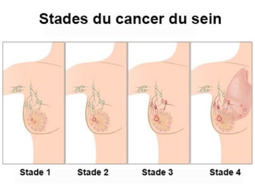 Cancer du seine traitement