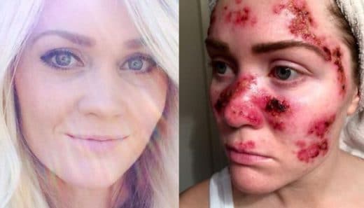 Cancer de la peau traitement naturel. cancer de la peau traitement crème