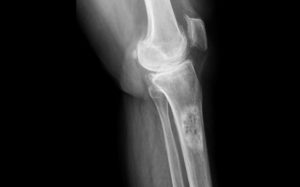 Cancer des os traitement naturel, nouveau, remède miracle, guérison