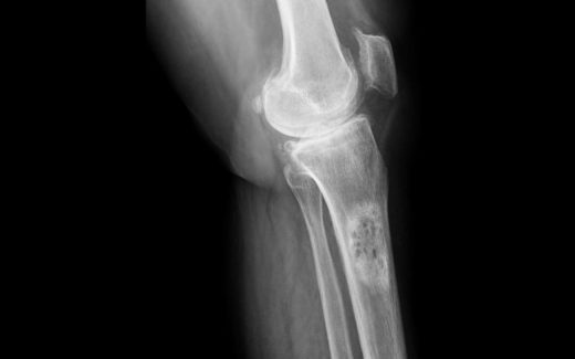 Cancer des os traitement naturel, nouveau, remède miracle, guérison