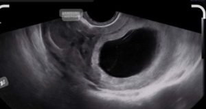 œuf clair traitement naturel. grossesse œuf clair, blanc, traitement naturel