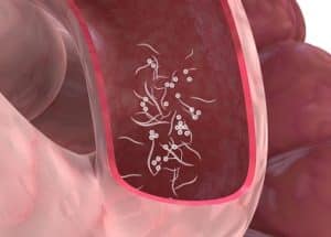 oxyures traitement naturel, ail. Oxyures remède de grand mère