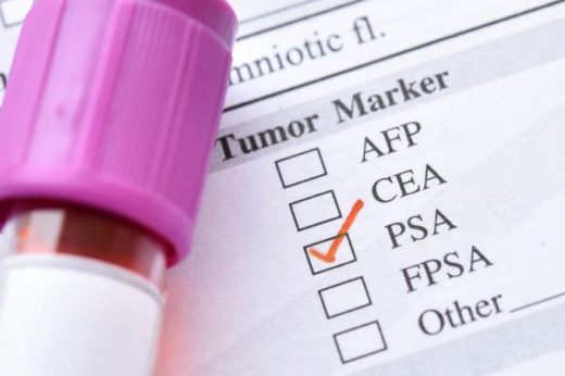 psa et cancer de la prostate, vélo. psa élevé traitement naturel