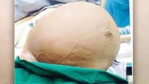 fibrome ventre gonflé. Fibrome et gonflement du ventre