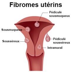 Témoignage guérison fibrome