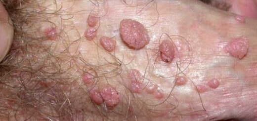 bouton dur sur les testicules