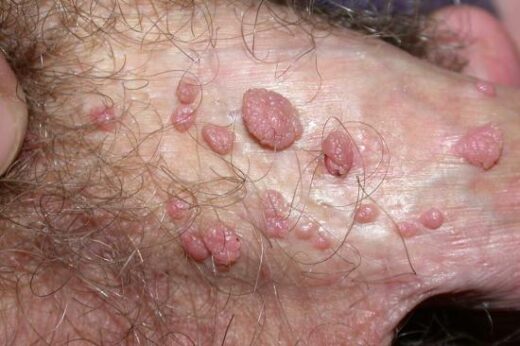 bouton dur sur les testicules