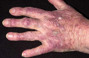 dermatomyosite et papules de gottron