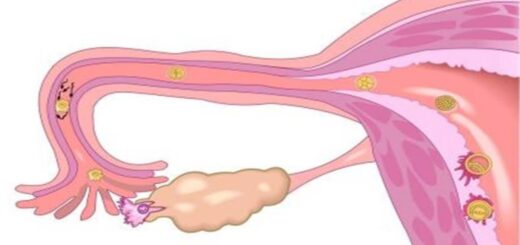 trompes bouchées et chlamydia
