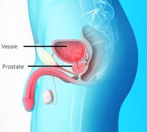 mon mari a un cancer de la prostate solution naturelle