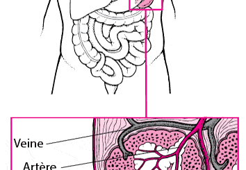 Comment soigner la rate traditionnellement Cameroun, usa