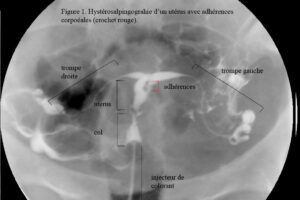 hystérosalpingographie trompe bouchée les déboucher