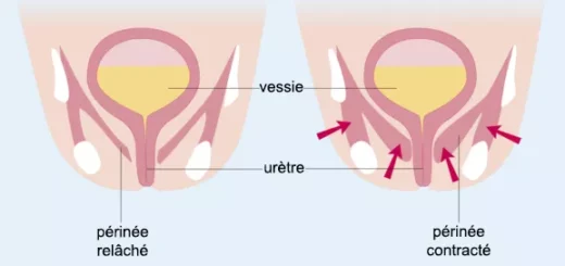 traitement naturel contre la descente d'organe
