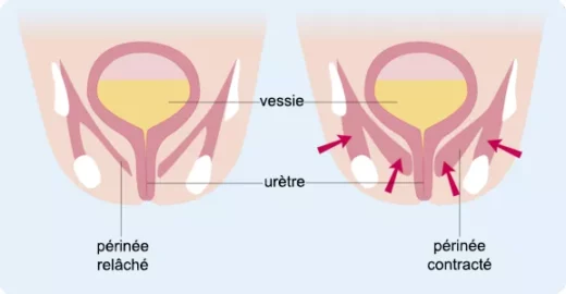 traitement naturel contre la descente d'organe