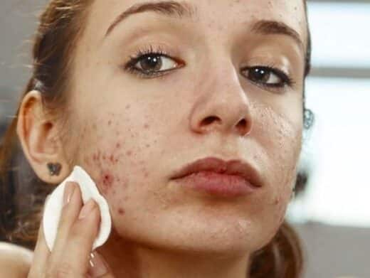 10 traitements naturels efficaces contre l'acné