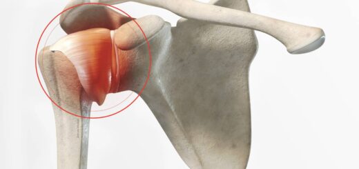 traitement naturel de la capsulite rétractile de l'épaule