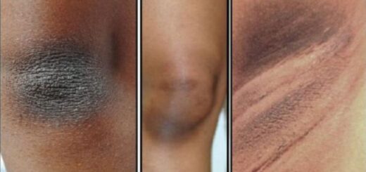 traitement naturel acanthosis nigricans