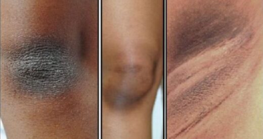 traitement naturel acanthosis nigricans