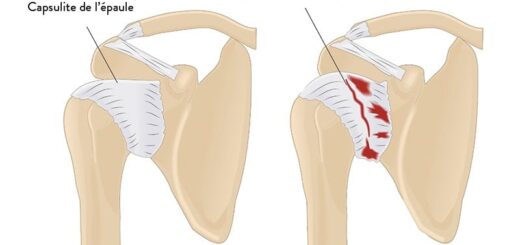 traitement naturel capsulite rétractile de l'épaule