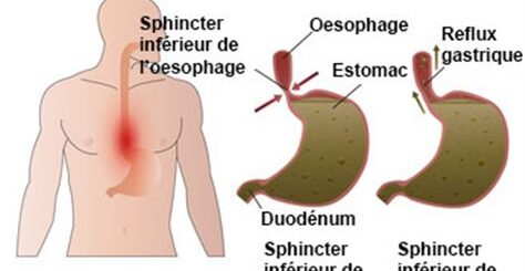 traitement naturel reflux gastrique