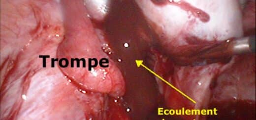 endométriome ovarien