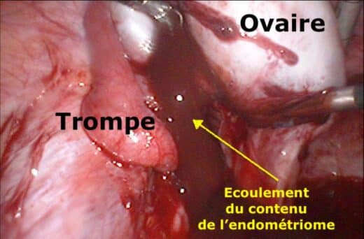 endométriome ovarien
