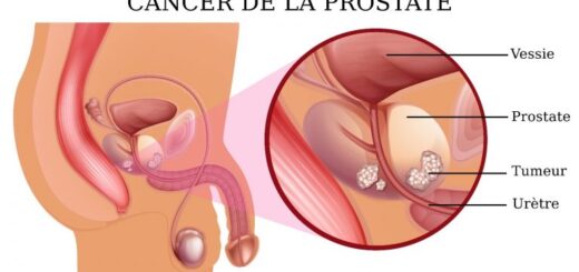 ablation de la prostate