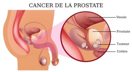 ablation de la prostate