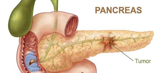 cancer du pancréas traitement naturel