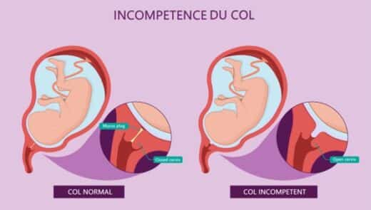 Béance du col témoignage