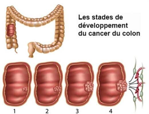 Cancer du côlon traitement naturel