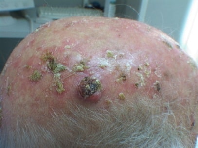 Kératose actinique traitement naturel