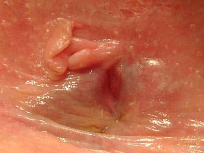 Fissures anales et hémorroides