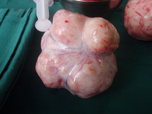 Vivagest et fibromes