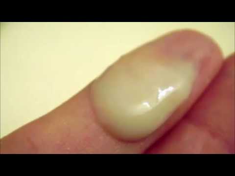 Pertes jaunes traitement naturel