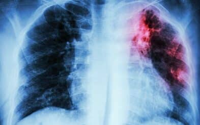 Fibrose pulmonaire traitement naturel