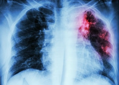 Fibrose pulmonaire traitement naturel