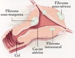 Bière et fibromes