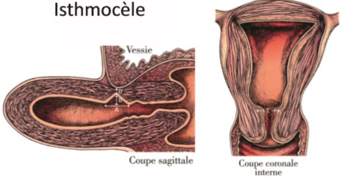 Traitement naturel Isthmocèle