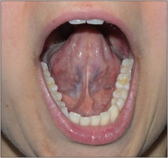 Glande salivaire gonflée traitement naturel