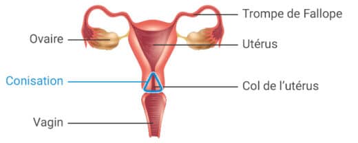Conisation du col utérin traitement naturel