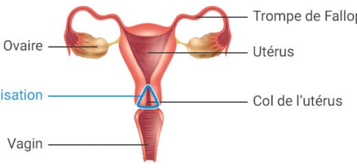 Conisation du col utérin traitement naturel