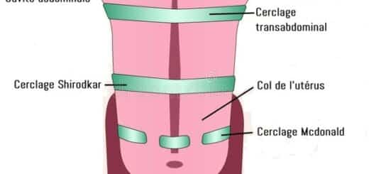 Cerclage grossesse et rapport