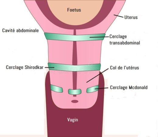 Cerclage grossesse et rapport