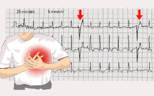 Extrasystole traitement naturel